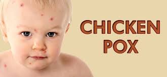 🍓 jadikan amalan, selepas susukan anak terus sendawakan dia. Tanda Tanda Ini Buat Saya Yakin 100 Anak Saya Dijangkiti Cacar Chickenpox Nutrisi Guru