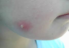 Ernstige ziektes die de mug kan overbrengen komen vooral voor in tropische gebieden. Muggenbeet Uitleg Van De Dermatoloog