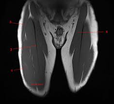 Upper third of the femur on the linea aspera and posterior proximal femur. Mri Of The Thigh Detailed Anatomy Superior Part W Radiology