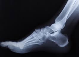 Image result for Ankle XRay