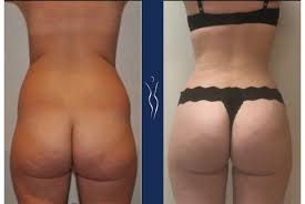 Those requiring more extensive liposuction may pay a little more. What Exactly Happens During A Brazilian Butt Lift