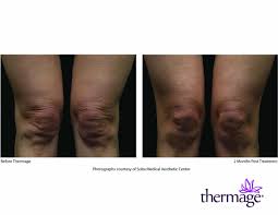 Md, director of the laser & skin surgery center of new york. Thermage Skin Tightening Treatment Charlotte Nc Med Spa