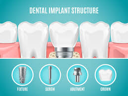 Image result for dental implant