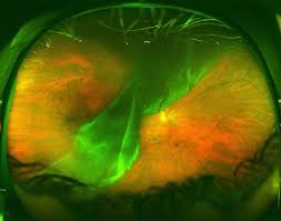 Eye injuries or traumas can. Floaters Retinal Tears And Retinal Detachments Visionaware