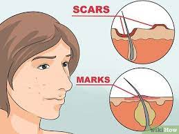 To learn more about acne scars and their treatment options, check out this very informative site. 5 Ways To Get Rid Of Red Acne Marks Wikihow