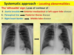 Chest X Ray Fundamentals X Ray Silhouette Sign Concept Map Nursing