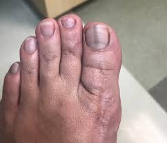 The most common malignant tumors that affect the nail matrix and nail bed are melanomas. Diagnosing And Treating Squamous Cell Carcinoma Of The Nail Bed Podiatry Today