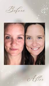 New facial bar for oily skin