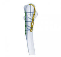 Olecranon Fixation System,Medical Device Manufacturers ...
