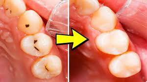 The dentist will dry the area of your gums where the numbing gel will be applied. How To Get Rid Of Cavities The Easy Way Doctor Sutera Explains
