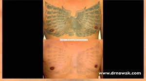 Brown spot and tattoo removal. San Diego Tattoo Removal