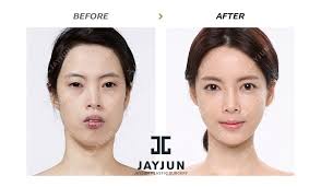 Korea is a very popular place to get plastic surgery done. Nose Surgery In Korea Rhinoplasty Revision In South Korea Korea Nose Surgery Korea Nose Revision Korea Nose Job Korea Asain Rhinoplasty Rhinoplasty In Korea Rhi