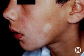 Image result for Postinflammatory Hypopigmentation