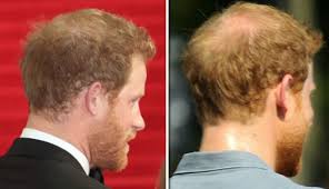 Is Prince Harry going BALD? Prince's ...