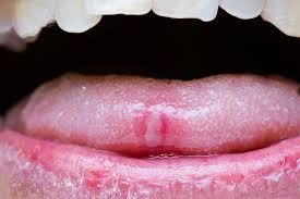 Download and use 7,000+ canker sore in mouth toddler stock photos for free. What Causes Canker Sores The New York Times