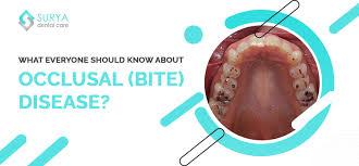 Image result for Occlusal