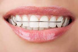 Check spelling or type a new query. How To Choose The Right Retainer Labbe Family Orthodontics