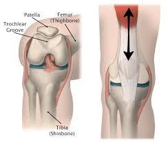 Patellofemoral Pain Syndrome Orthoinfo Aaos
