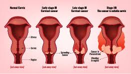 A cell's dna contains the instructions that tell a cell what to. Cervical Cancer Symptoms Causes Treatment Narayana Health