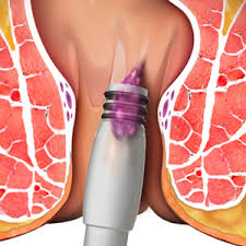 Image result for Hemorrhoid