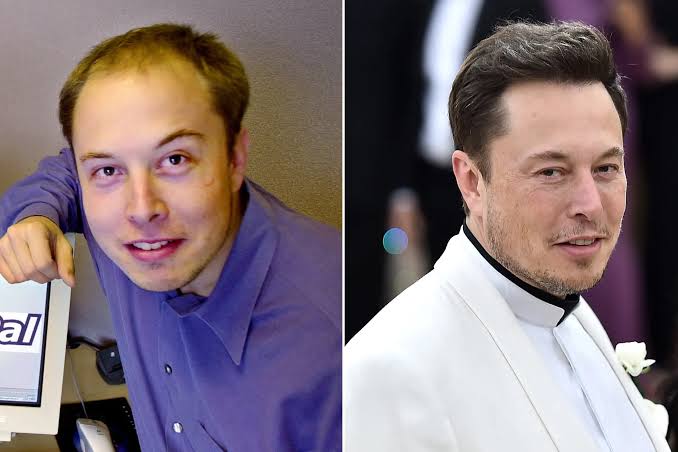 Elon Musk's Hair Transplant | Unveiling His Hair Transformation