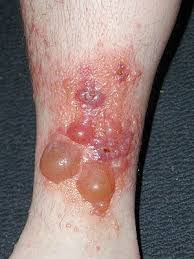 Pin On Rashes