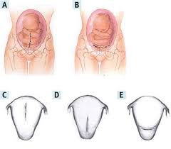 Pdf The History Of The Low Transverse Cesarean Section The Pivotal Role Of Munro Kerr Semantic Scholar