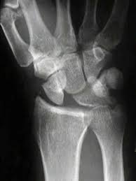 Image result for Scapholunate Dislocation