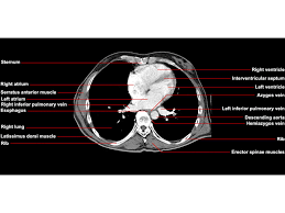 They provide movements﻿ of the spine functional anatomy: Ct Of The Chest Soft Tissue Windows Axial Anatomy Radiologypics Com