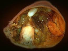 Ovarian Teratoma Monsters Inside Me Ep1 Ovarian Tumor Ovarian Teratoma Ovarian
