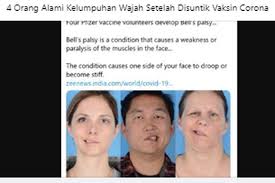 Bell's palsy adalah diagnosis klinis. Klarifikasi Klaim Foto Orang Yang Alami Bell S Palsy Setelah Suntik Vaksin Corona Halaman All Kompas Com