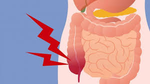One of the most disconcerting symptoms people report is red blood in their stools, and that's probably a common cause of alarm for most people. Colon Cancer Symptoms What To Look For
