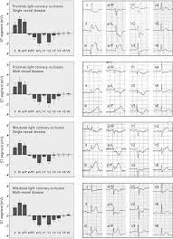 Electrocardiographic Changes Induced By Acute Occlusion Of The Right Download Scientific Diagram