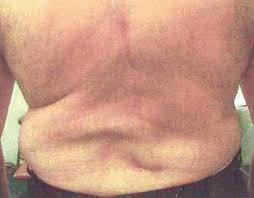 The erector spinae are the longest muscles in your body and are found on either side of the spine. Adhesive Arachnoiditis A Clinical Update