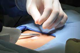 Como E Feita A Cirurgia De Hernia Umbilical Hernia Clinic