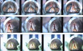 Voice therapy is recommended as a … Steps Of The Wendler S Glottoplasty Procedure Used To Feminize The Download Scientific Diagram
