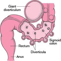 Diverticulitis most often causes abdominal pain, which is . Quick Facts Diverticulitis Msd Manual Consumer Version