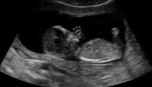 Image result for First Trimester Ultrasound