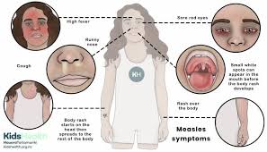 Image result for measles