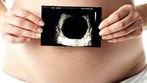 But when the embryo stops growing and hormone levels decrease, pregnancy symptoms subside. Blighted Ovum Symptoms And Causes
