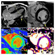Myocarditis care at mayo clinic. The Unique Role Of Cardiovascular Magnetic F1000research