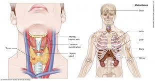 It is difficult to be very specific without having more detailed information. Thyroid Cancer Stages Cancer Net