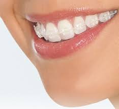 What is it like to have braces? Dental Insurance With No Maximum Limit Dental Insurance That Covers Invisalign