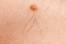 It is not uncommon for a mole to change gradually over time. The Early Signs Of Skin Cancer Dermatologist In Milford Ct