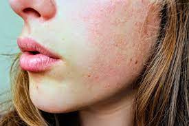 Skin Care Sensitivity And Propylene Glycol Healthy Panacea
