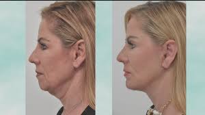 Cfa beauty medical spa, ultherapy, botox, juvederm, coolsculpting and more. Marietta Facial Plastic Surgery Laser Aesthetics Center 11alive Com