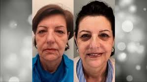 Lifting de los 8 puntos, el tratamiento que REVOLUCIONÓ la medicina  estética.