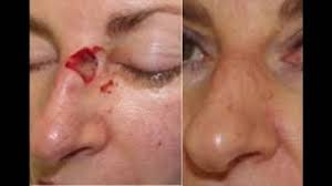 Anir dhir specializes in mohs micrographic surgery and the most advanced. Using Skin Reconstruction After Mohs Surgery Vlog Uk Aesthetic