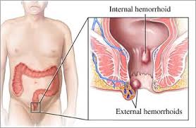 Hemorrhoid Banding Norwich Gi Associates