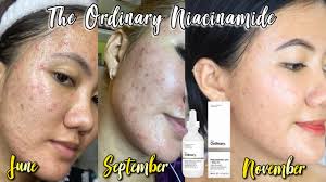 The ordinary niacinamide (vitamin b3) 10% + zinc 1% serum reduces the appearance of skin blemishes and congestion while also balancing otherwise, niacinamide can affect integrity of the vitamin c. Acne Breakout The Ordinary Niacinamide 10 Zinc 1 Review Result By Beautybypatm Youtube